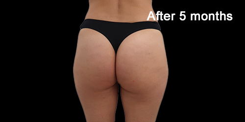 Buttock-case-treatment-by-Dr-LEAH_1_After