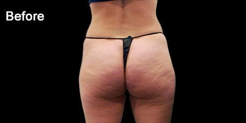 Buttock-case-treatment-by-Dr-LEAH_1_Before
