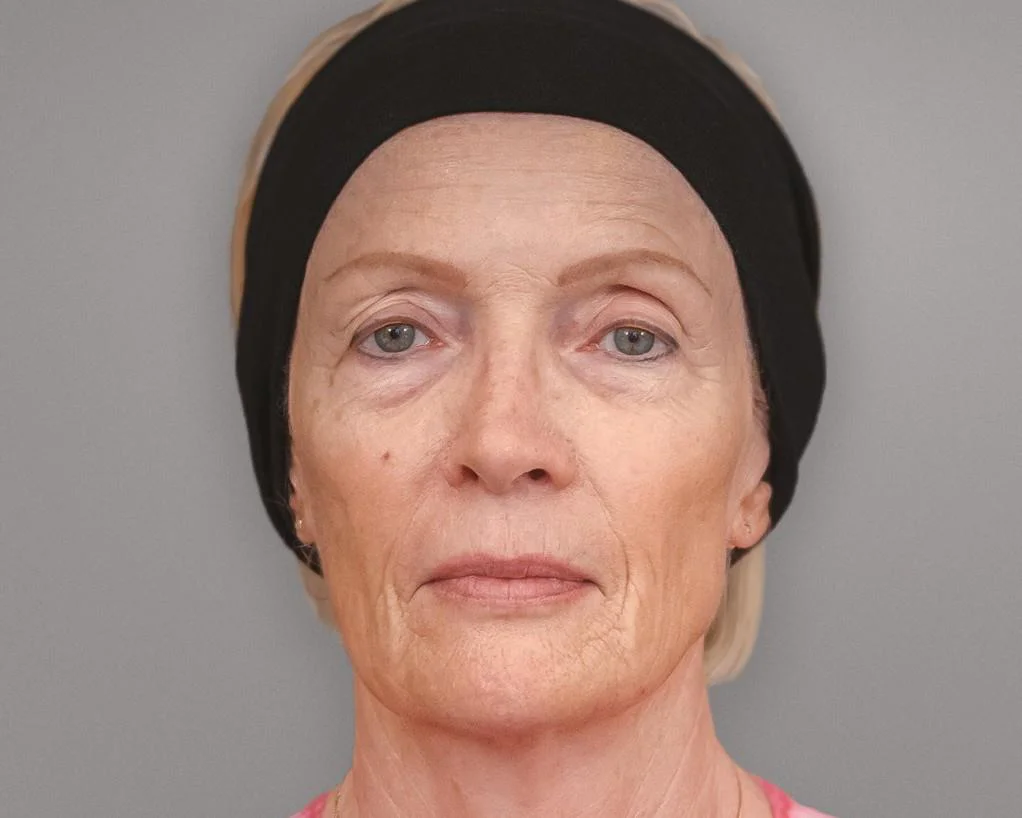 Case_1_After-_24-months