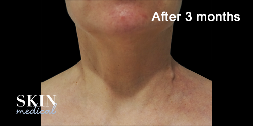 Neck-case-2-image-3-months-after-treatment-by-Sabika-Karim_2