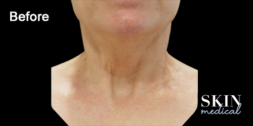 Neck-case-2-image-before-treatment-by-Sabika-Karim_2
