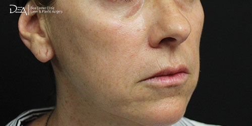 Patient1-A-Side copy