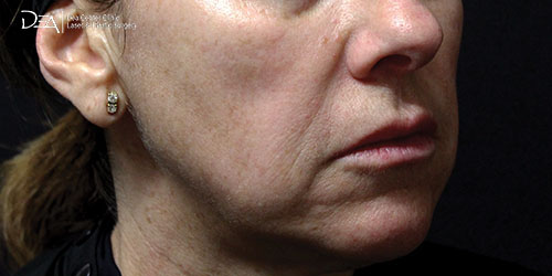 Patient1-B-side copy