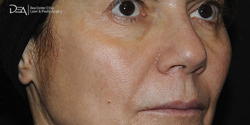 Patient2-A-Side-mid-face